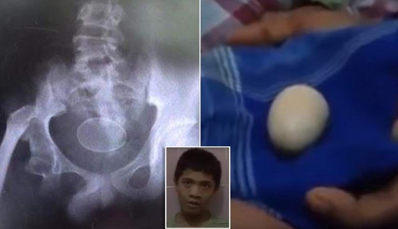 Индонезийский подросток, откладывающий яйца, удивил врачей