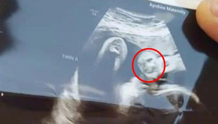 Беременная женщина разглядела на УЗИ очертания лица умершего дедушки
